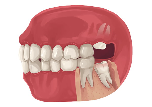 wisdom-teeth-extraction-1635506432.jpg