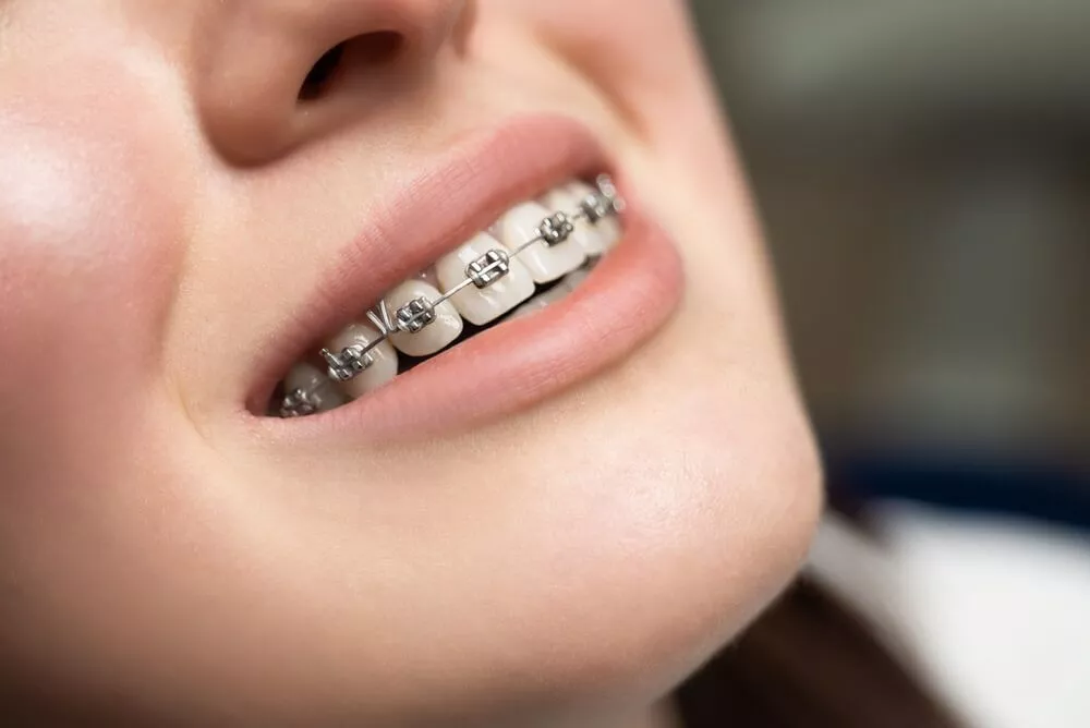 types-of-braces-1648491073-1680684057.webp