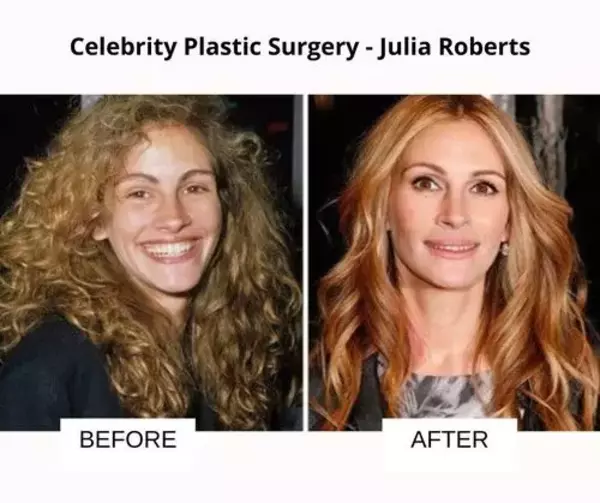 medium-julia-roberts-plastic-surgery-1700468227.webp